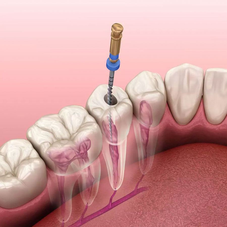 endodonciia