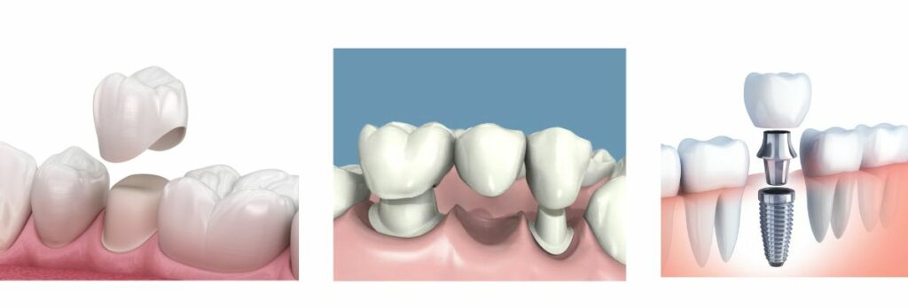 periodontitis-grafic-es (1)