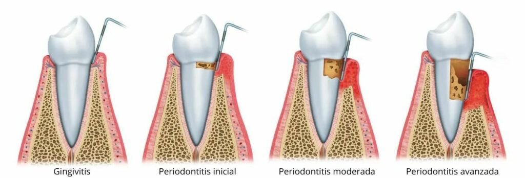 periodontitis-grafic-es