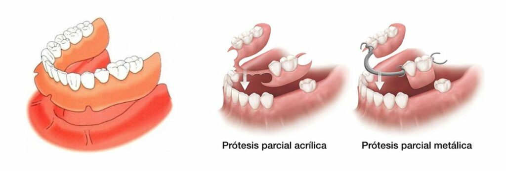 periodontitis-grafic-es (2)