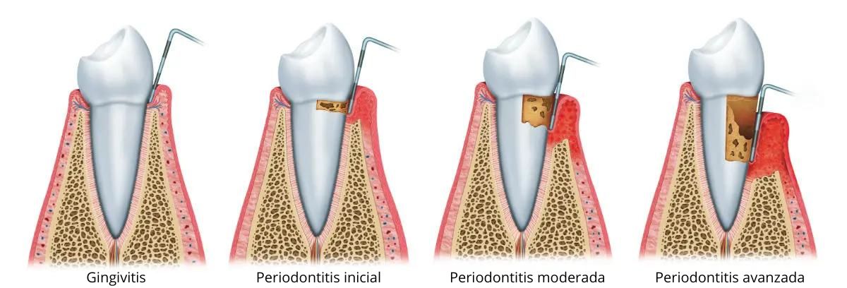 periodontitis-grafic-es