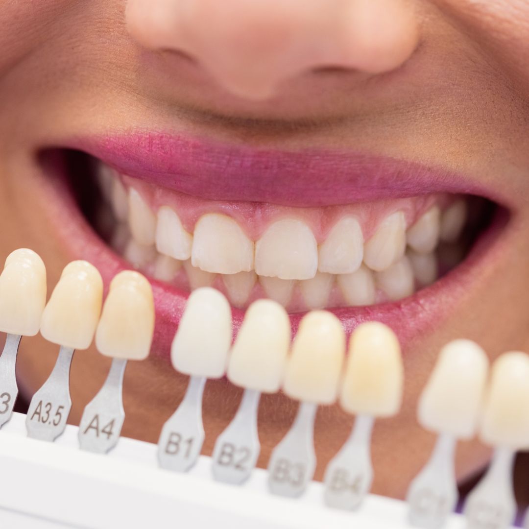estetica dental (2)