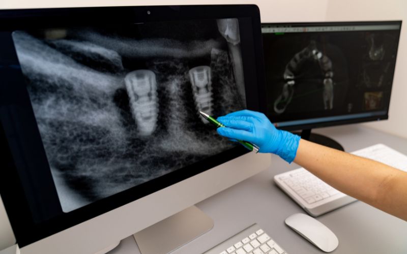 implantologia dental (1)