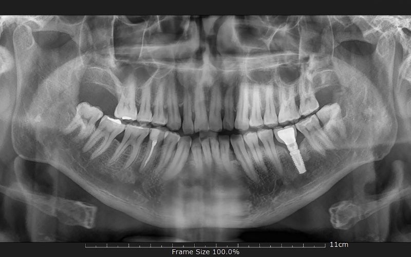 implantologia dental